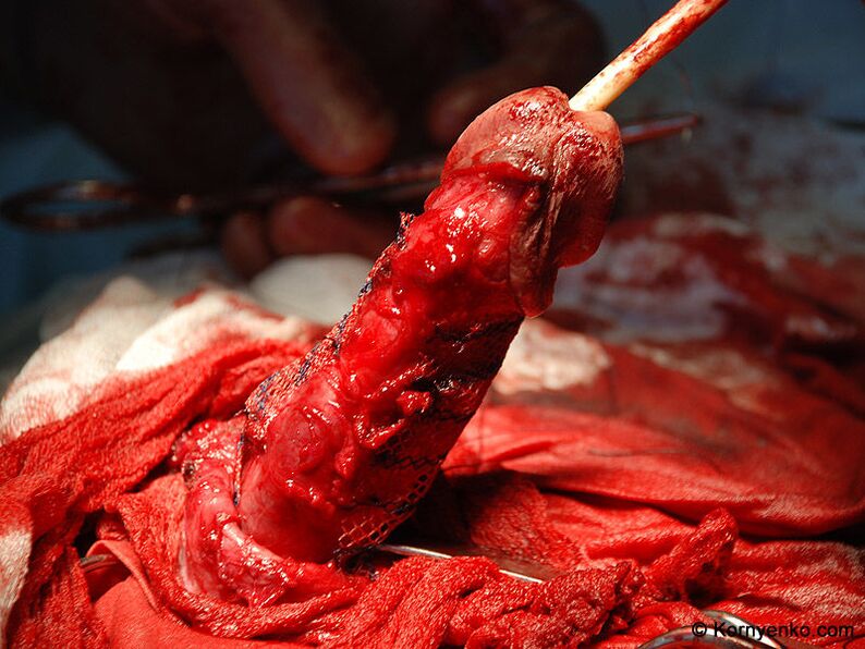 Installation d'une matrice de collagène pour l'agrandissement du pénis