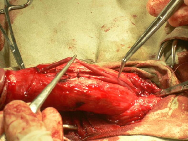 Lipofilling du pénis pour agrandir