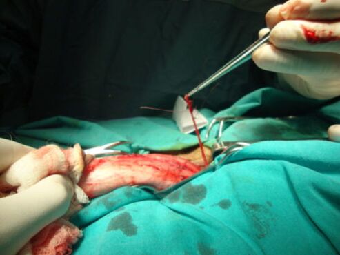 Chirurgie d'agrandissement du pénis